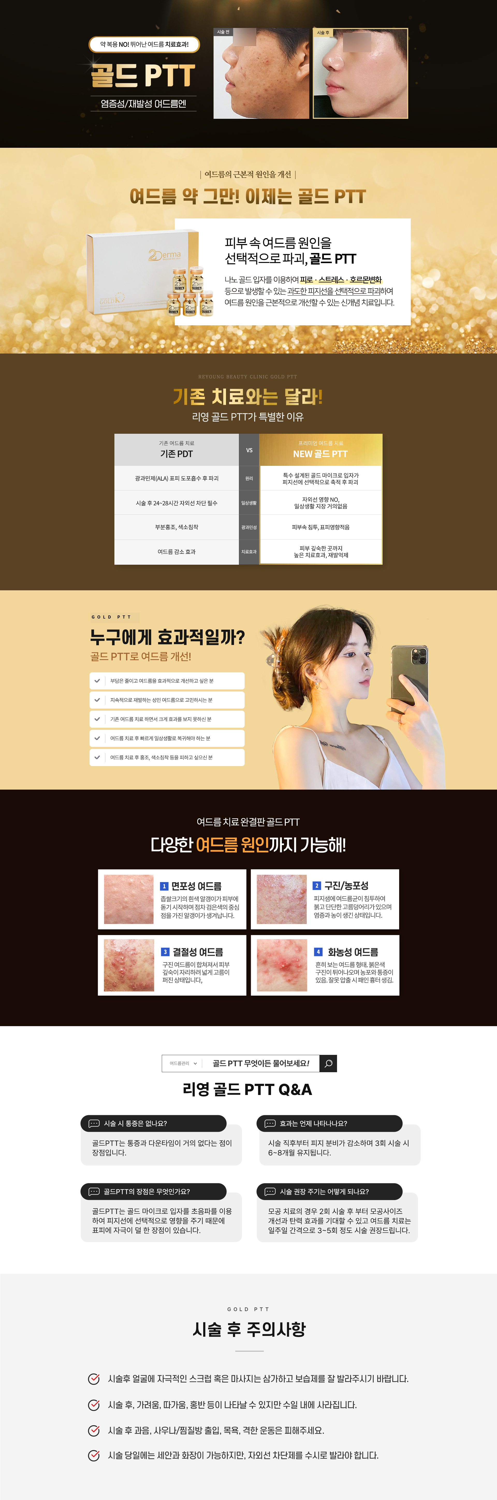 약  복용 NO! 뛰어난 여드름 치료효과! 염증성/재발성 여드름엔! 골드 PTT