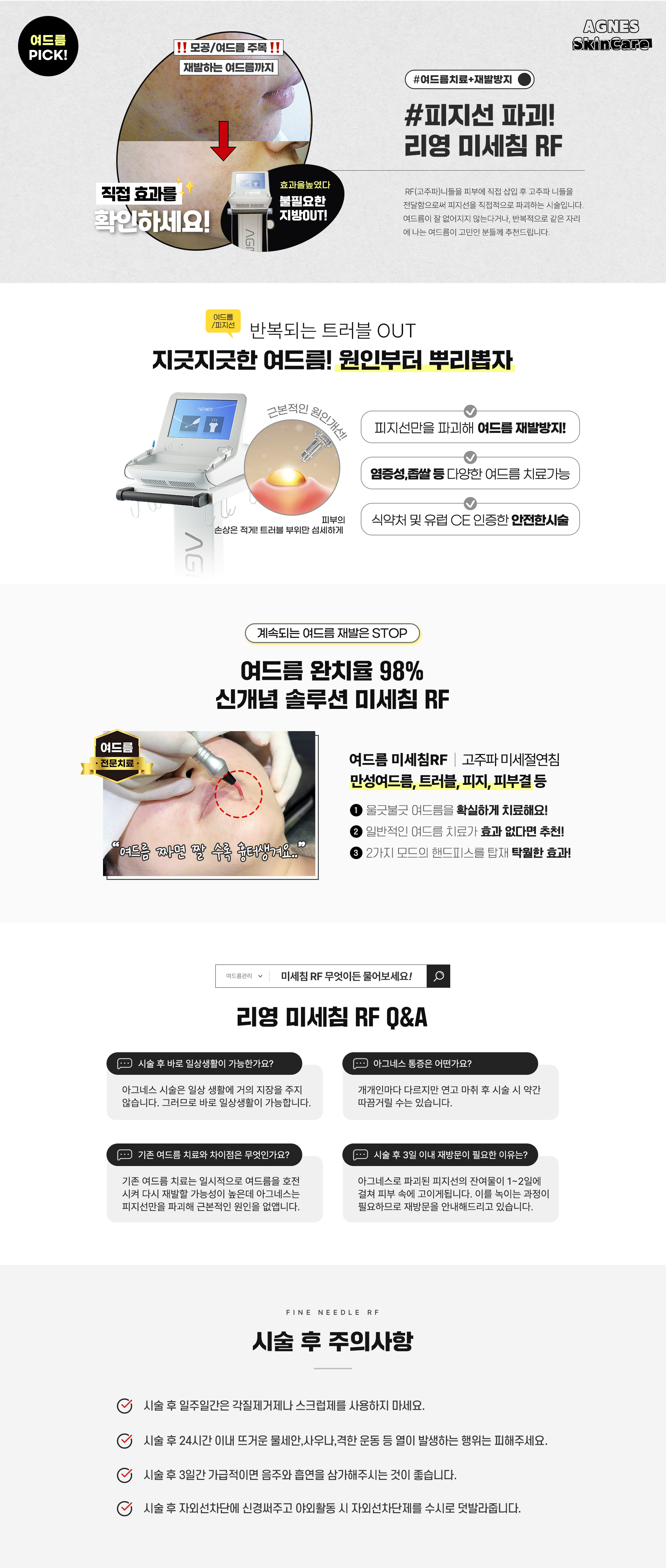 여드름치료+재발방지! 피지선 파괴! 리영 미세침 RF